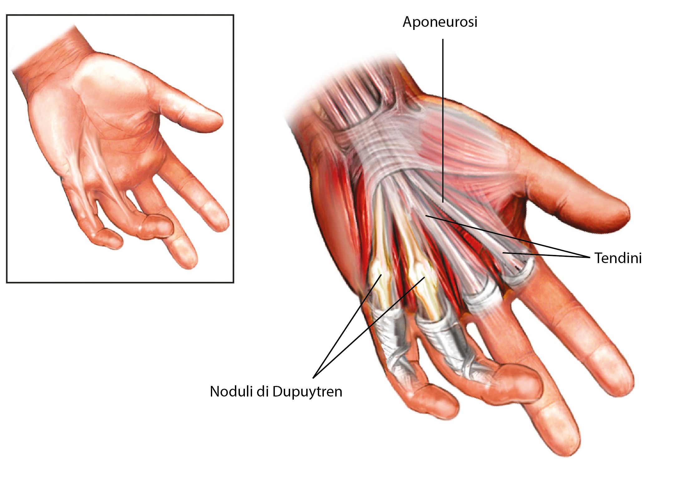 Rizartrosi (Artrosi) Trapezio-Metacarpale