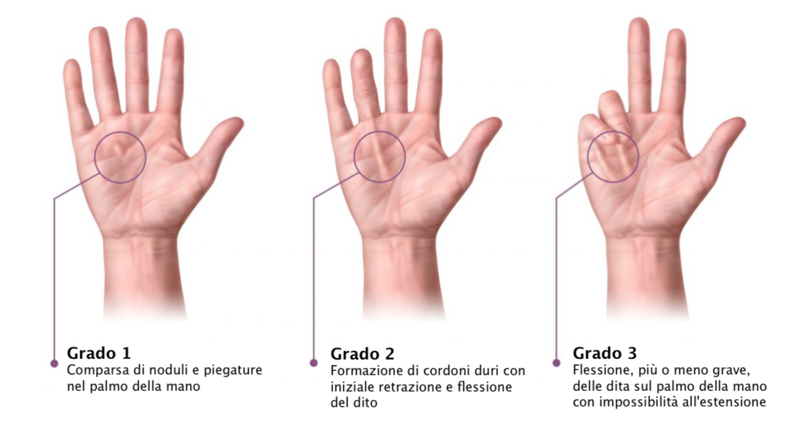 Rizartrosi (Artrosi) Trapezio-Metacarpale