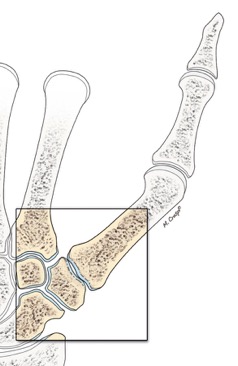 Rizartrosi (Artrosi) Trapezio-Metacarpale