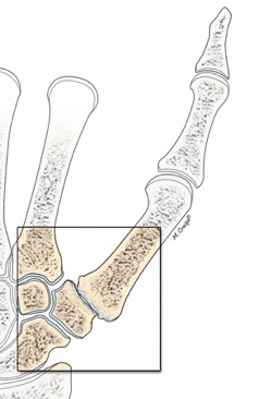 Rizartrosi (Artrosi) Trapezio-Metacarpale