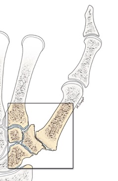 Rizartrosi (Artrosi) Trapezio-Metacarpale