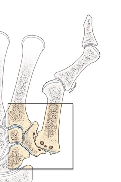 Rizartrosi (Artrosi) Trapezio-Metacarpale