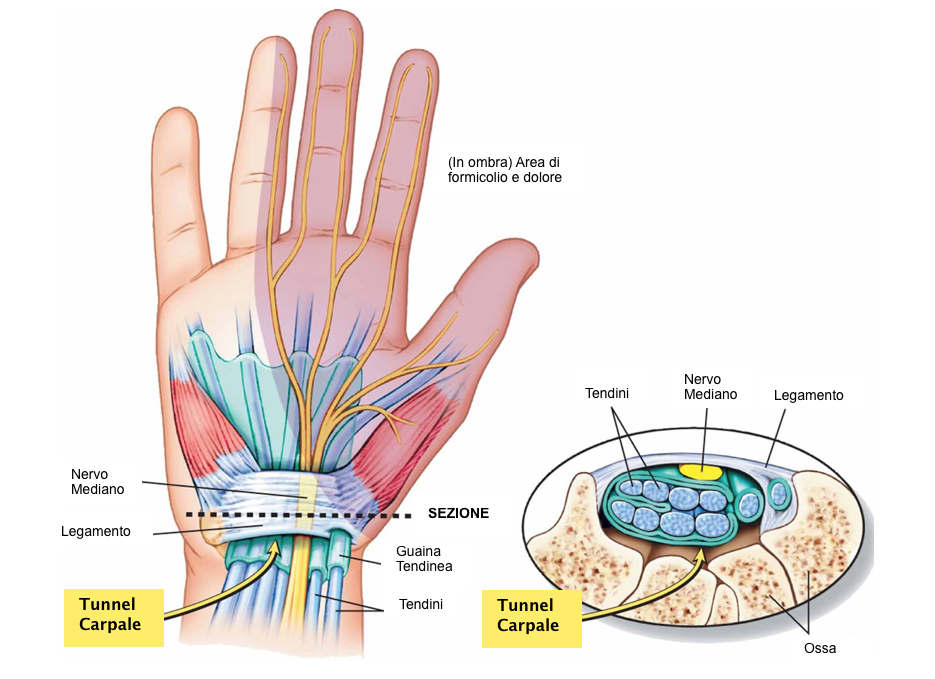 sindrome del tunnel carpale