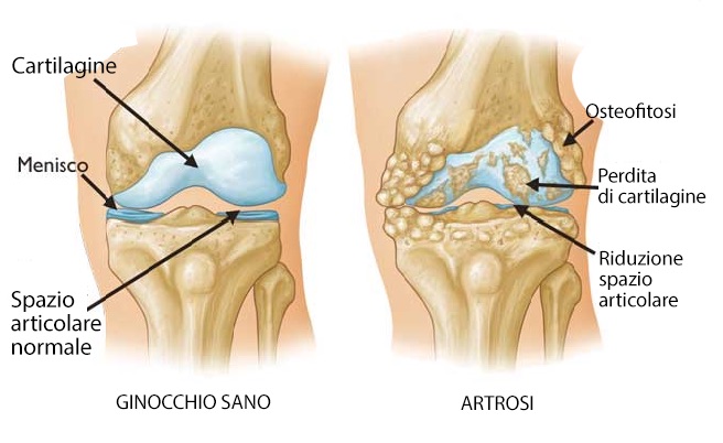 Osteofitosi, perdita di cartilagine
